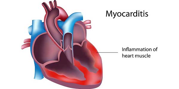 Bệnh viêm cơ tim – Nguyên nhân, các triệu chứng và một số thực phẩm hỗ trợ điều trị bệnh