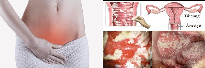 Viêm nhiễm phụ khoa trở nặng