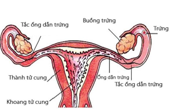 Viêm ống dẫn trứng chủ yếu do vi khuẩn gây lên