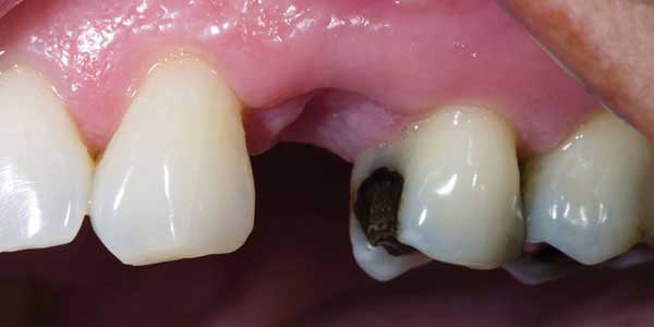 Bệnh tủy răng: nguyên nhân, triệu chứng và các biện pháp tự nhiên giúp phòng chống và điều trị bệnh hiệu quả tại nhà