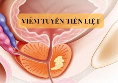 Viêm tuyến tiền liệt 