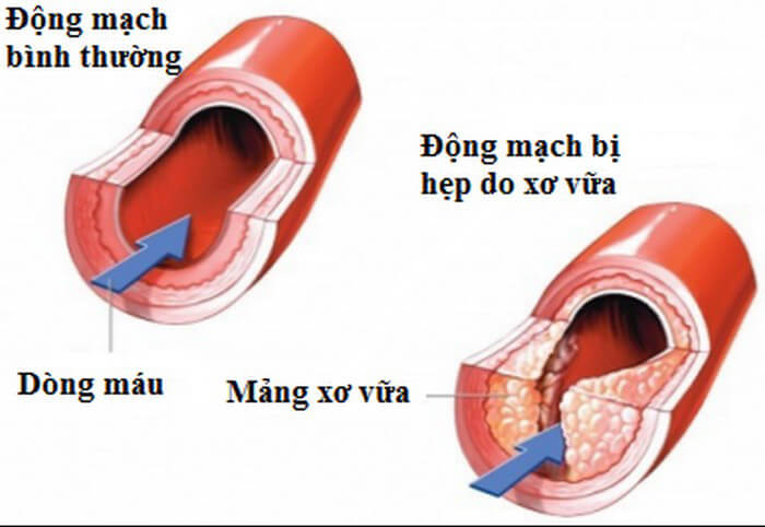 Xơ vữa động mạch