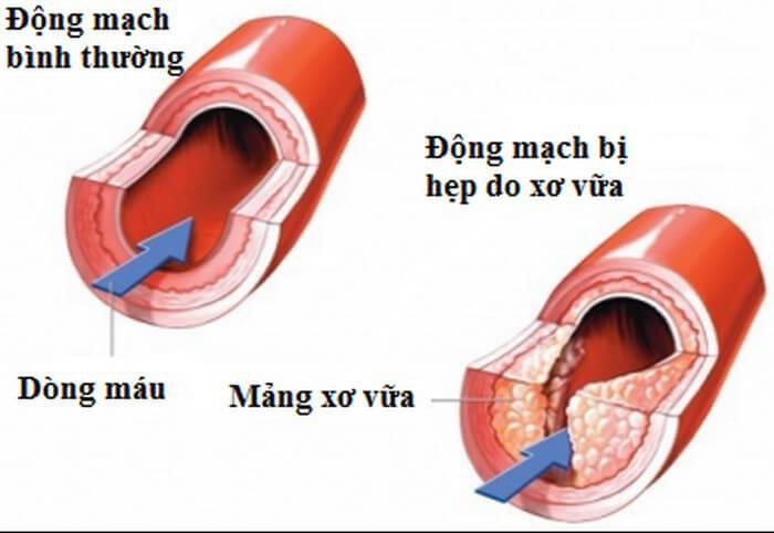 Xơ vữa động mạch