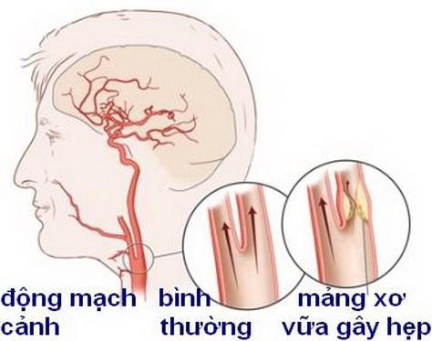 Xơ vữa động mạch cảnh