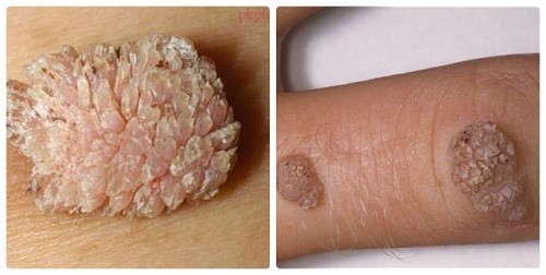 Xuất hiện các mảng như mào gà