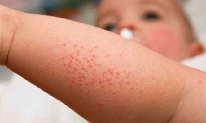 Xuất hiện các nốt phát ban trên toàn cơ thể khi mắc bệnh sởi